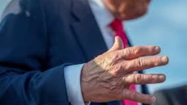 Trump diagnosed with vein condition causing leg swelling, White House says