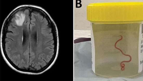 Live worm found in Australian woman’s brain in world first