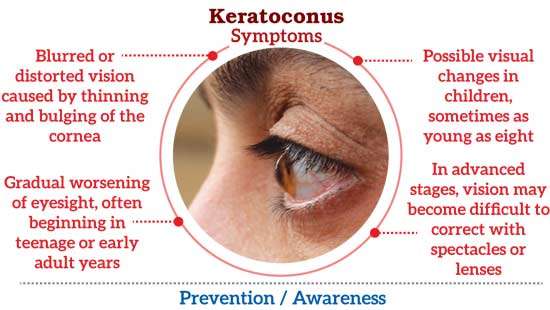 Keratoconus on the rise National Eye Hospital warns  of growing eye disorder in  Sri Lanka