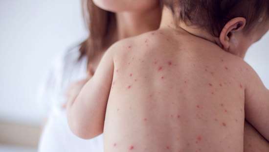 Measles infection cases at LRH increasing: Paediatrician