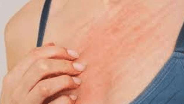 Spike in skin diseases sparks health warning