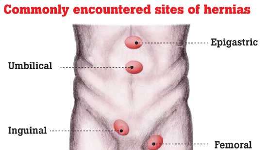 Treating Hernia