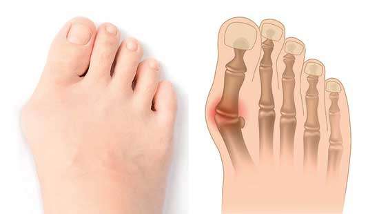 Troublesome foot conditions explained