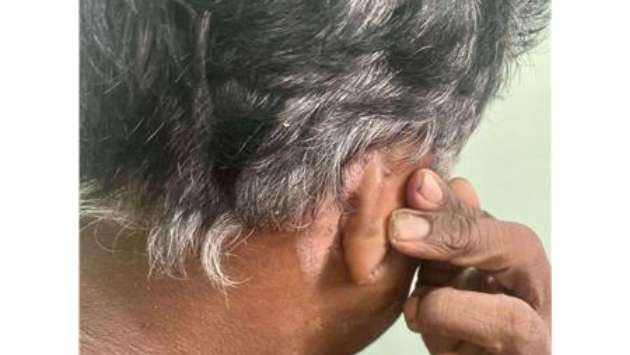 Leprosy in Moratuwa increasing