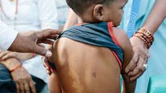 Children under 15 among 12% of annual leprosy cases