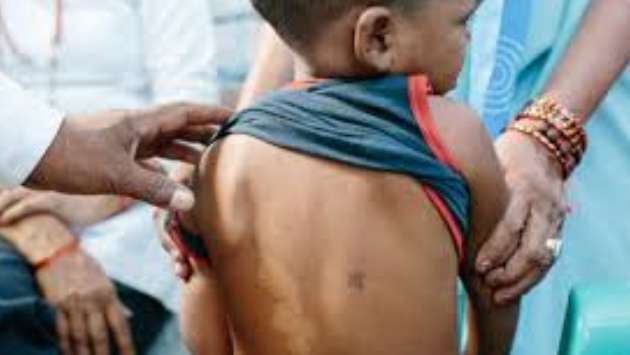 1,282 new Leprosy cases reported in 2025, including 123 children under 15