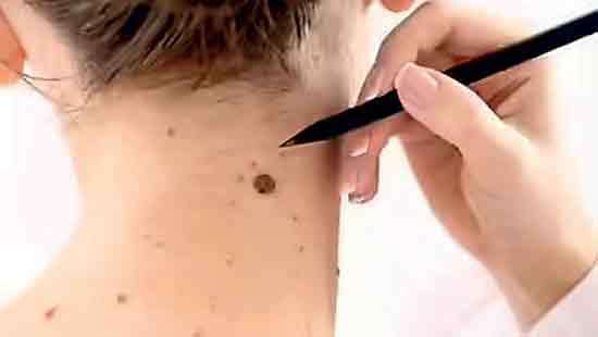 Health officials warn of rising skin cancer cases