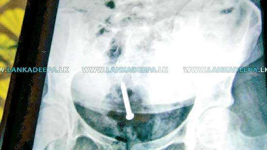 House maid beaten and forced to swallow nails