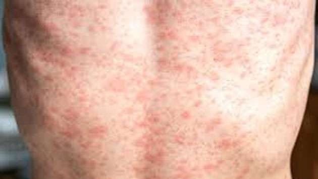 Health Ministry goes on alert over potential measles outbreak