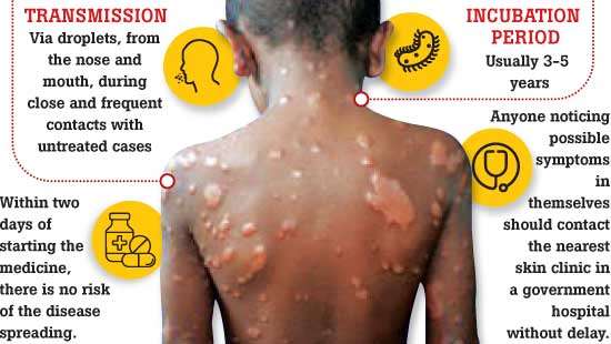 Sri Lanka reports over 1,500 leprosy cases including children