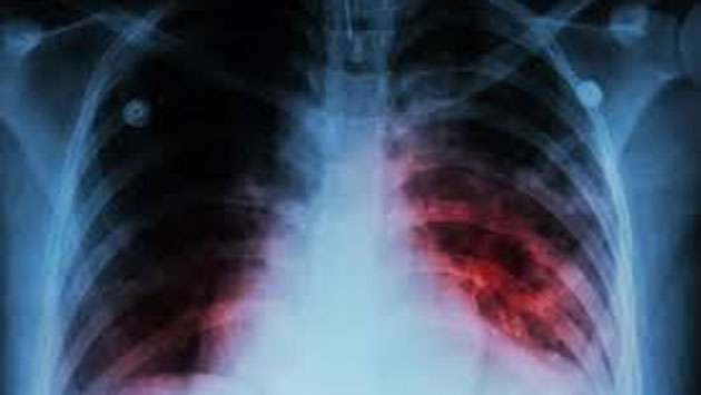 Sri Lanka faces 5,000 undiagnosed TB cases: Health officials