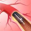 CID seeks Health Ministry probe into substandard cardiac devices