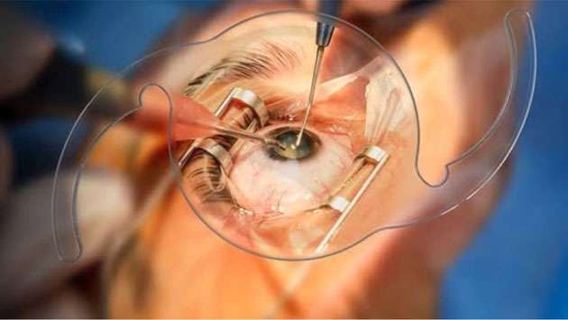 Special cataract surgery drive to reduce patient waiting list
