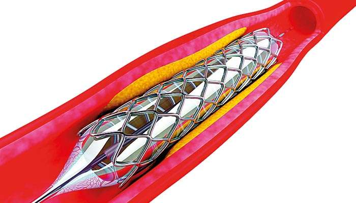 Three types of cardiac stents withdrawn immediately due to safety concerns
