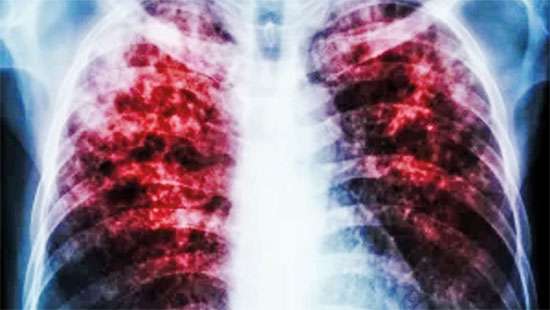 REFLECTIONS ON TUBERCULOSIS