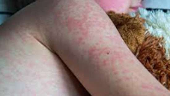 Measles raising its head again, special vaccination drive to be launched