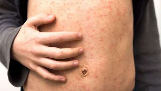’Fast-spreading’ measles outbreak hits several schools in London