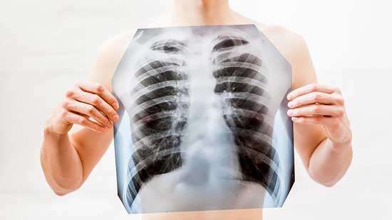 Resurgence of the SpectRE of Tuberculosis