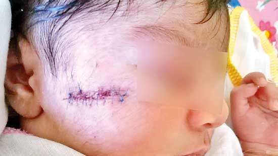 Doctors blame newborn for gash on her face