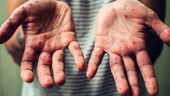Increase in spread of hand, foot and mouth disease among children: Pediatrician