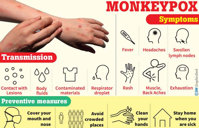 Sri Lanka braces for possible monkeypox threat