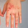 Hand, Foot, and Mouth disease on the rise