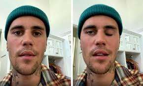 Justin Bieber says he has facial paralysis due to Ramsay Hunt syndrome