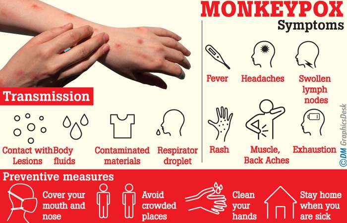 Sri Lanka on alert amid global rise in Monkeypox cases: Allays immediate threat