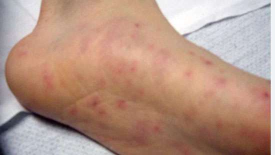 Meningococcal disease enters Colombo?