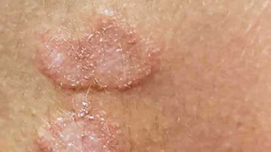 Health authorities concerned over spread of “TINEA”