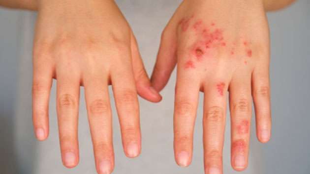 Hand, Foot, and Mouth disease on the rise