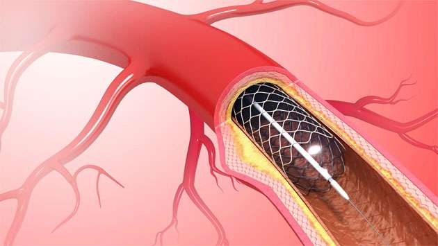 CID seeks Health Ministry probe into substandard cardiac devices
