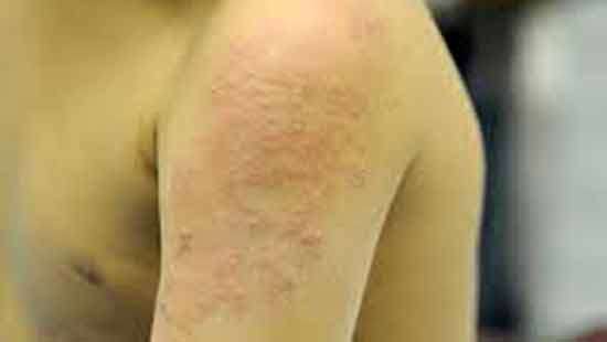 Increase in skin diseases among children; don’t fear to bathe them: Pediatrician