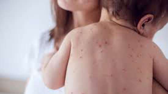 Measles shows an increase among those unvaccinated: Paediatrician