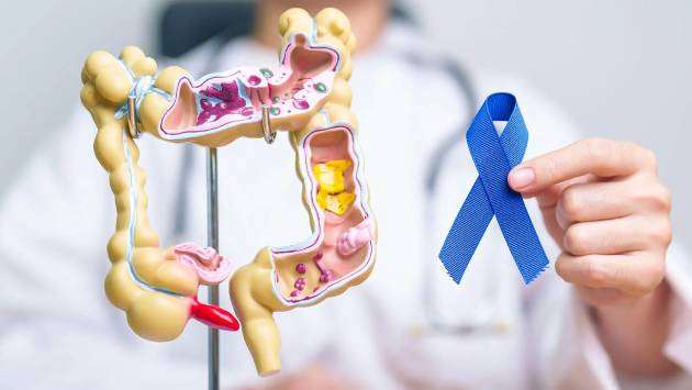 Sri Lanka raises alarm over rising Colorectal Cancer cases
