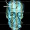 Court orders a report on Duminda’s skull parts