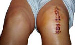 Doctor operates on wrong knee