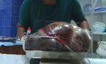 Docs remove 14-kg abnormal growth in ovary