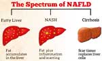 Preventing non-alcoholic fatty liver