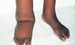 SL declared as Filaria free