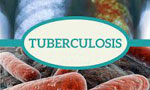 TB spreading in Colombo: CMC