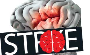 Stroke Preventable with early detection