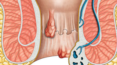 Tackling haemorrhoids