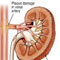 Students in NCP at risk of contracting renal disease