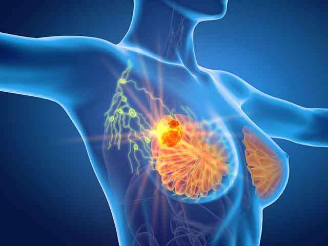 MY MOTHER’S JOURNEY WITH TRIPLE NEGATIVE BREAST CANCER