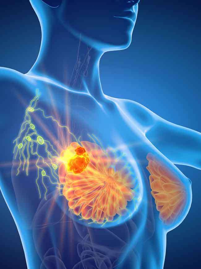 MY MOTHER’S JOURNEY WITH TRIPLE NEGATIVE BREAST CANCER